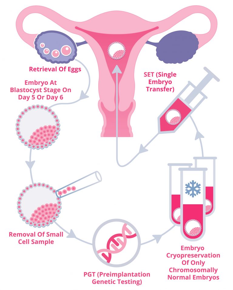 IVF Success With Single Embryo Transfer And PGT | IRMS